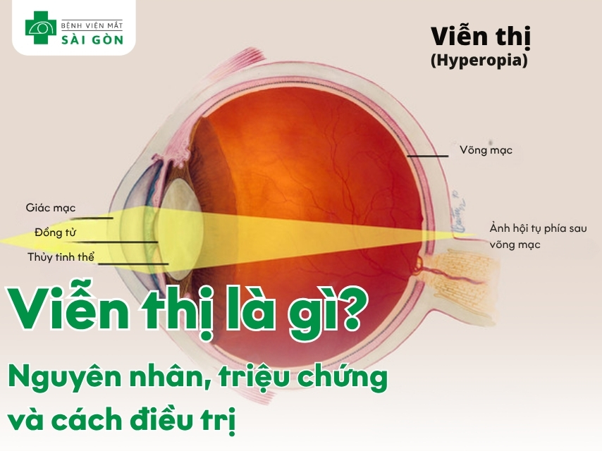 Tổng quan về tình trạng viễn thị mắt