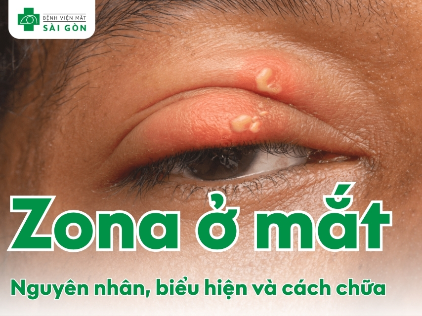 Tìm hiểu chi tiết bệnh Zona thần kinh mắt