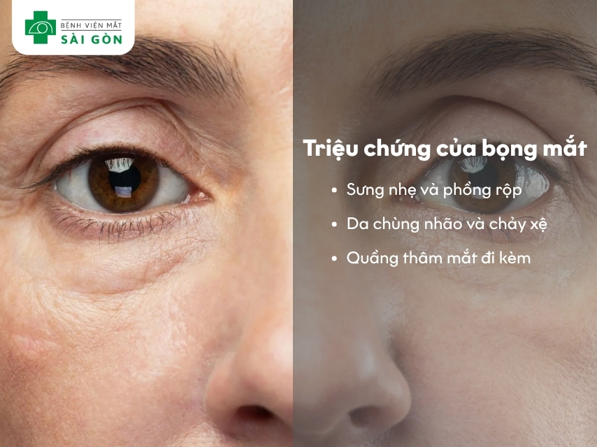 Triệu chứng của bọng mắt