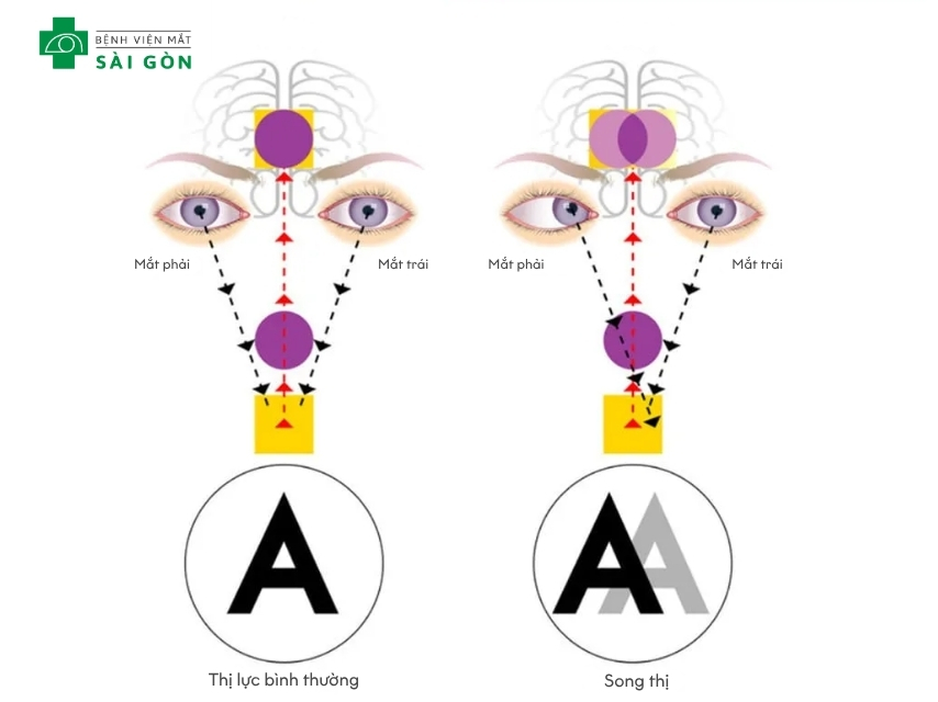 Mắt lồi gây tình trạng song thị