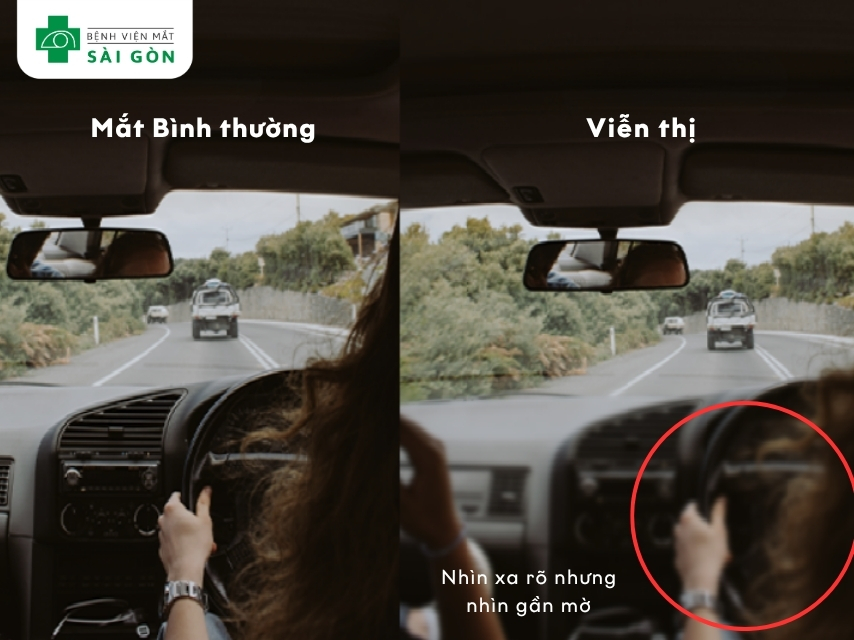 Mắt mỏi khi nhìn gần đặc trưng viễn thị