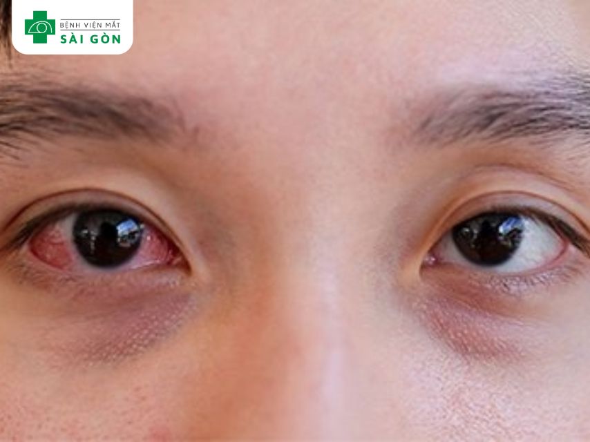Triệu chứng đau mắt đỏ