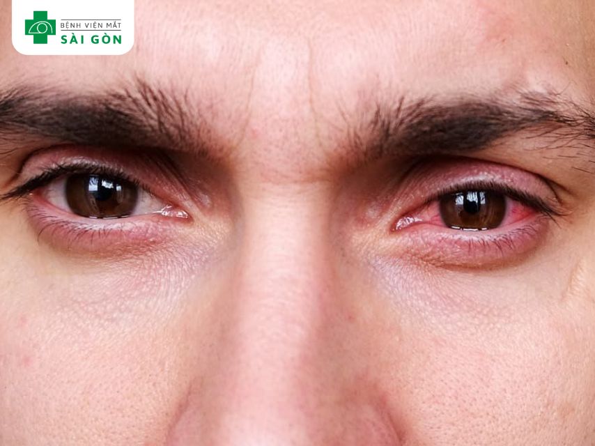 Chảy nước mắt liên tục