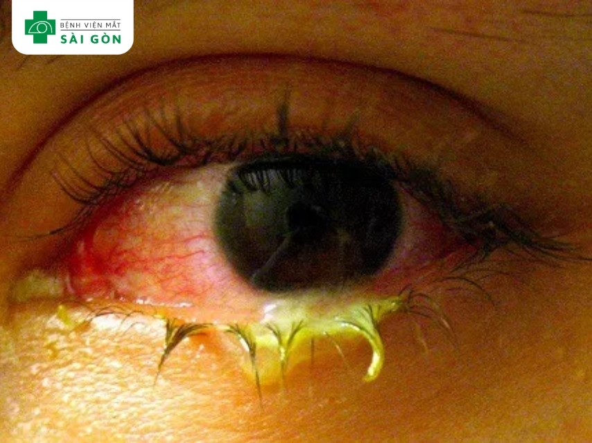 Ghèn mắt nhiều, có nhầy hoặc mủ, xuất hiện rõ vào buổi sáng