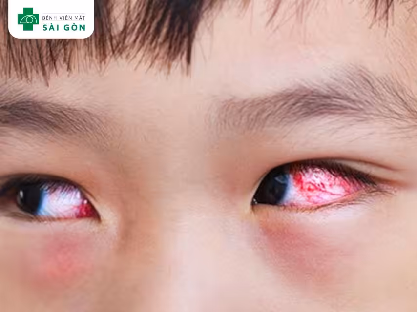 Ngứa và đỏ mắt