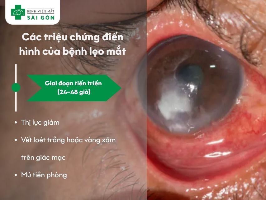 Triệu chứng giai đoạn tiến triển viêm giác mạc