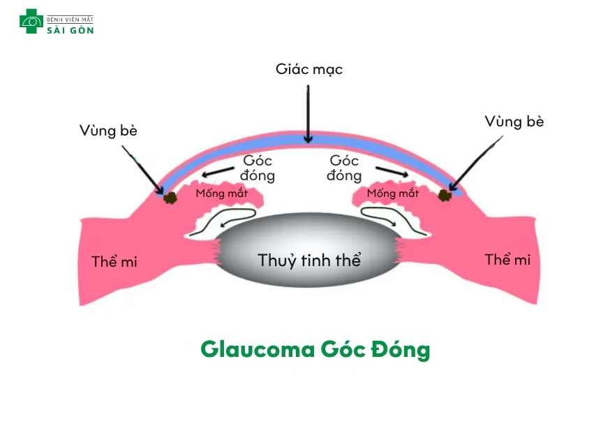 Glaucoma góc đóng làm mắt thị lực nhanh chóng