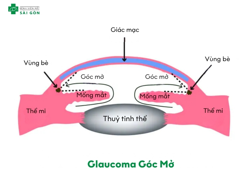 Glaucoma góc mở tiến triển chậm