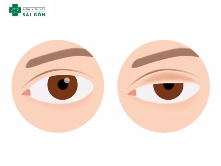 Đồng tử bên bị ảnh hưởng nhỏ hơn bên đối diện