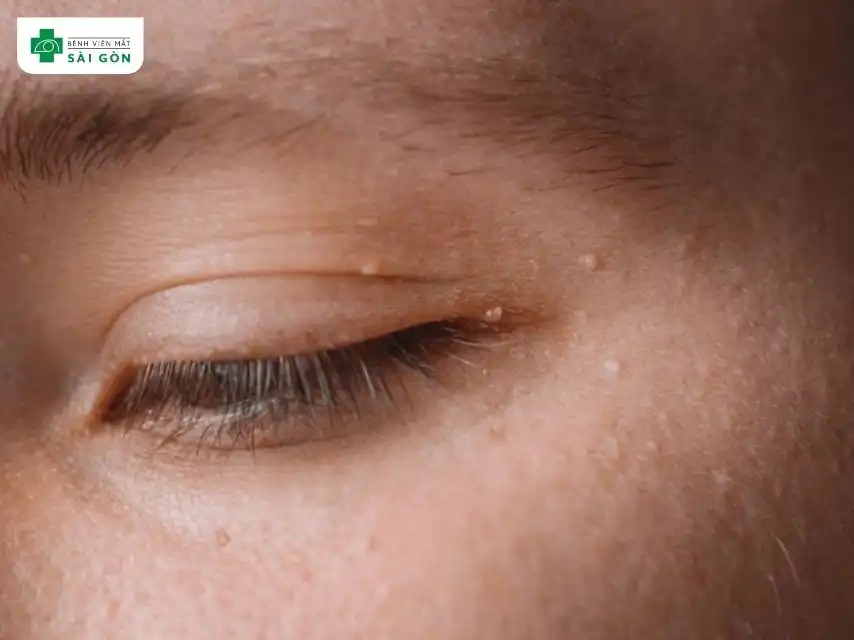 Các triệu chứng khi mí mắt trên nổi mụn trắng