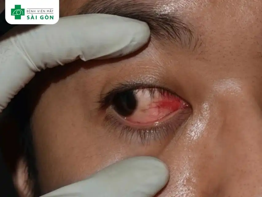 Đỏ mắt, sưng mi mắt và đau nhức