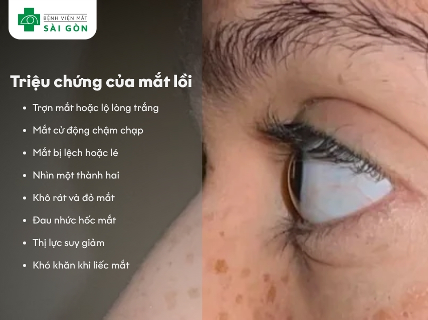 Tình trạng song thị ở mắt lồi, bệnh nhân thấy một vật thành hai hình chồng chéo nhau.