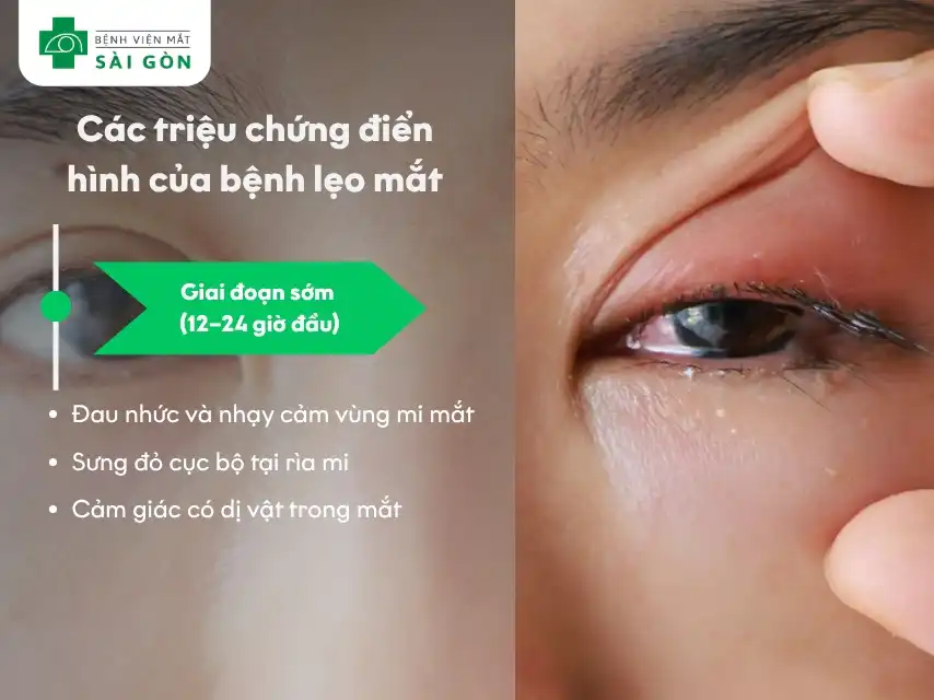 Triệu chứng nhận biết sớm của lẹo mắt