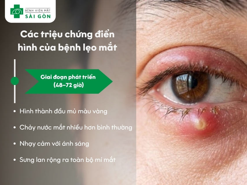 Triệu chứng giai đoạn phát triển lẹo mắt