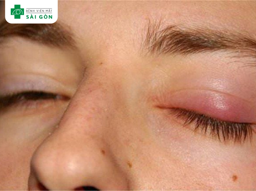 Đau sưng mắt là dấu hiệu sớm bị lẹo mắt