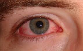 Đỏ mắt: Các nguyên nhân và nguy cơ gây giảm thị lực