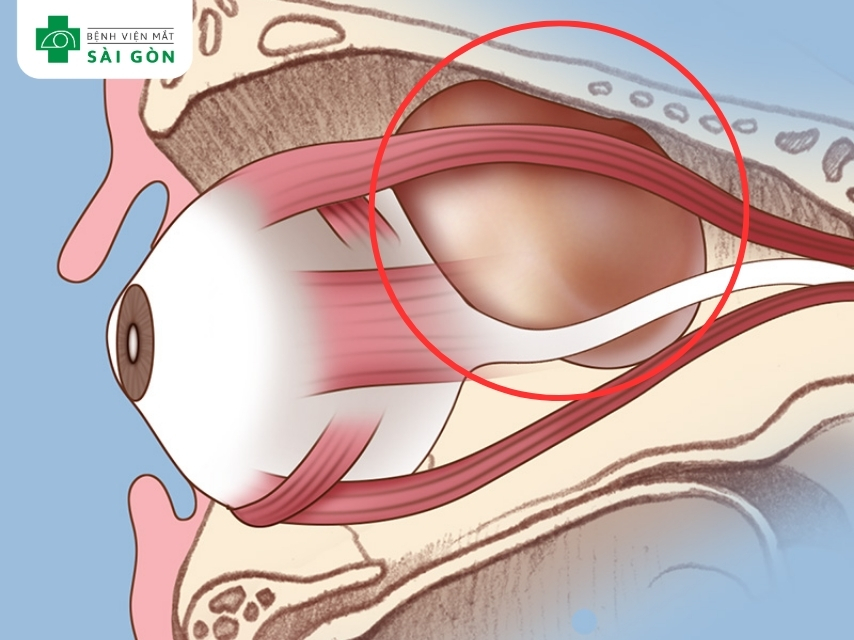 U hốc mắt gây mắt lồi