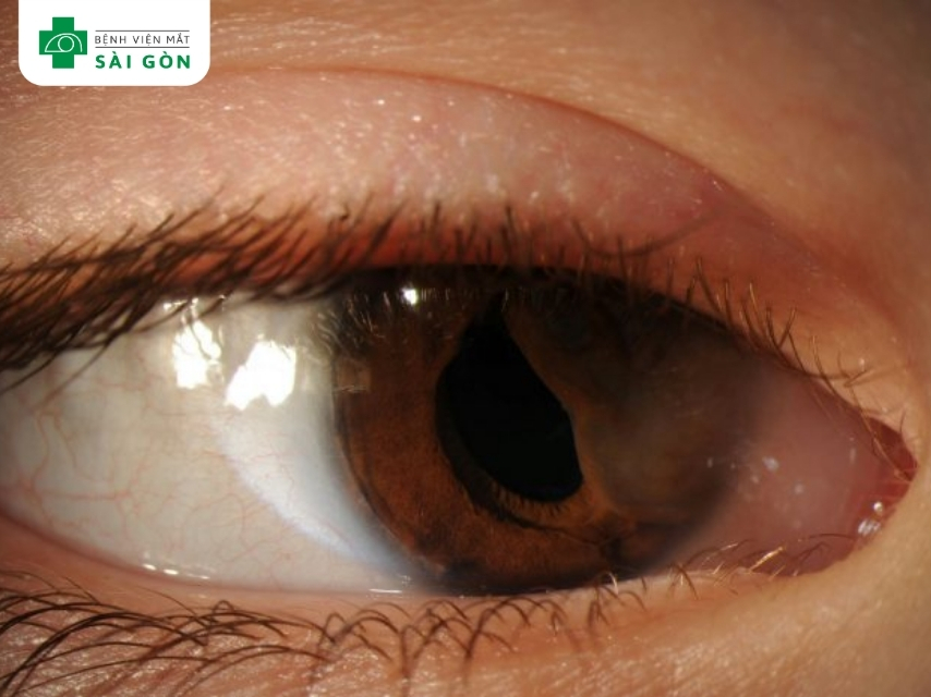 Các khối nang trên mống mắt là u nang