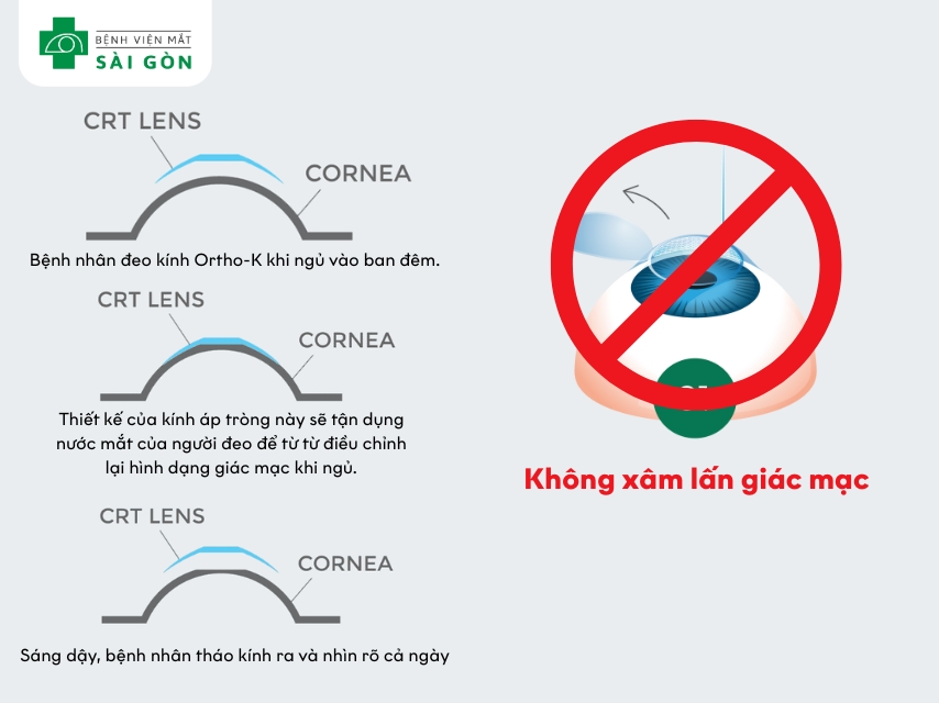 Kính Ortho-K không xâm lấn giác mạc