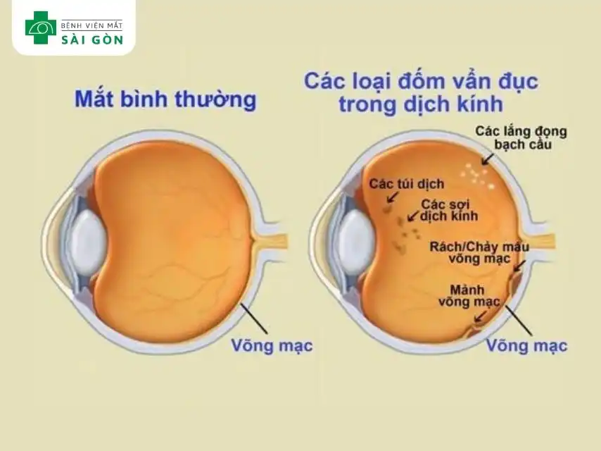 Vẩn đục dịch kính là những hình dạng nhỏ, tối màu trôi nổi trong tầm nhìn