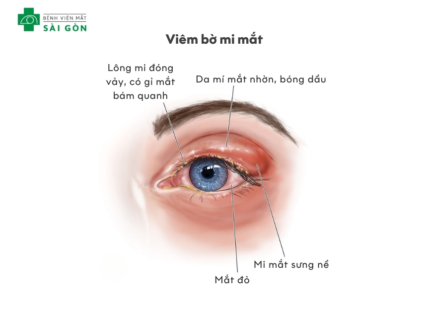 Vệ sinh mi mắt hàng ngày bằng khăn ấm giúp giảm viêm bờ mi