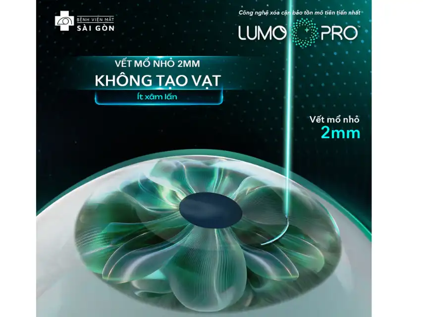 LUMOPRO™ giúp tiết kiệm mô giác mạc, chỉ 2mm