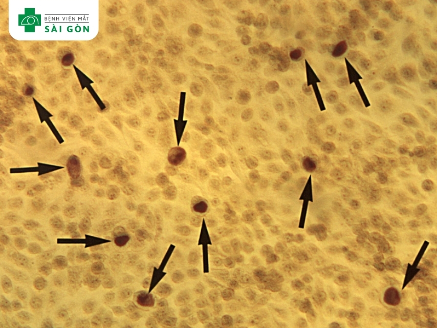 Đau mắt hột do vi khuẩn Chlamydia trachomatis gây ra