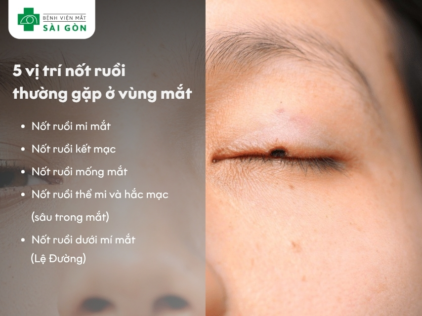 Nốt ruồi ở mi mắt là vị trí phổ biến nhất