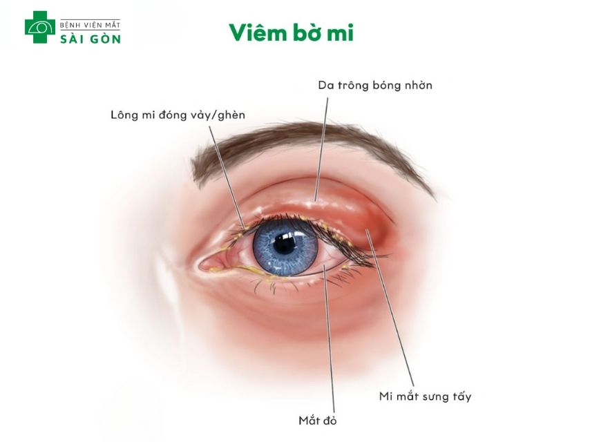 Viêm bờ mi gây đỏ, sưng và ngứa ở vùng mí mắt