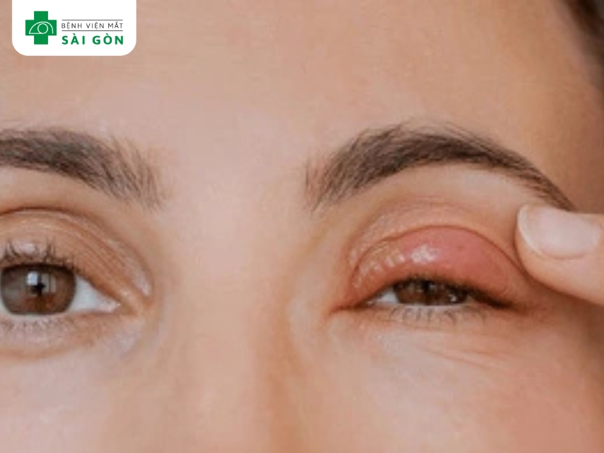 Viêm bờ mi do tụ cầu phổ biến