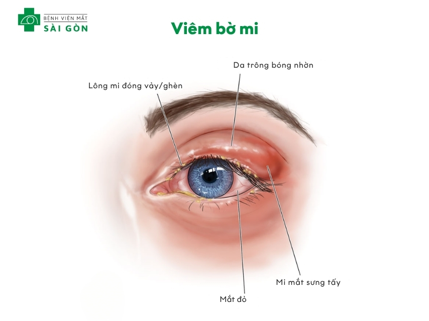 Viêm bờ mi là viêm mãn tính tại bờ mi