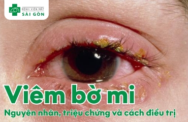 Tổng quan viêm bờ mi