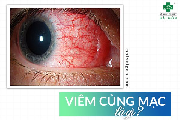 Triệu chứng viêm củng mạc với mắt đỏ sâu, đau nhức và nhạy cảm ánh sáng