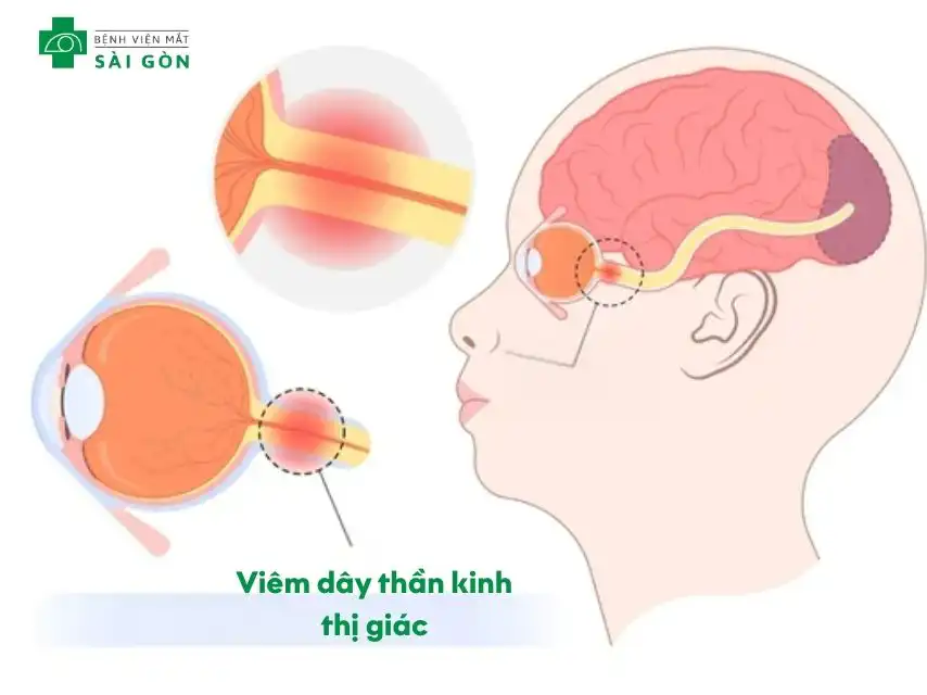 Viêm dây thần kinh thị giác