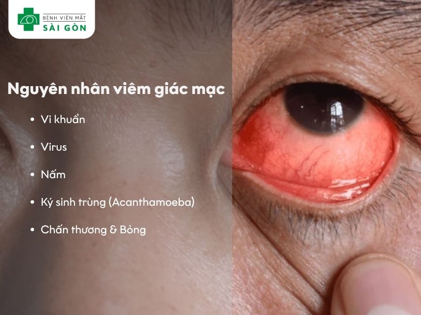 Nguyên nhân gây viêm giác mạc