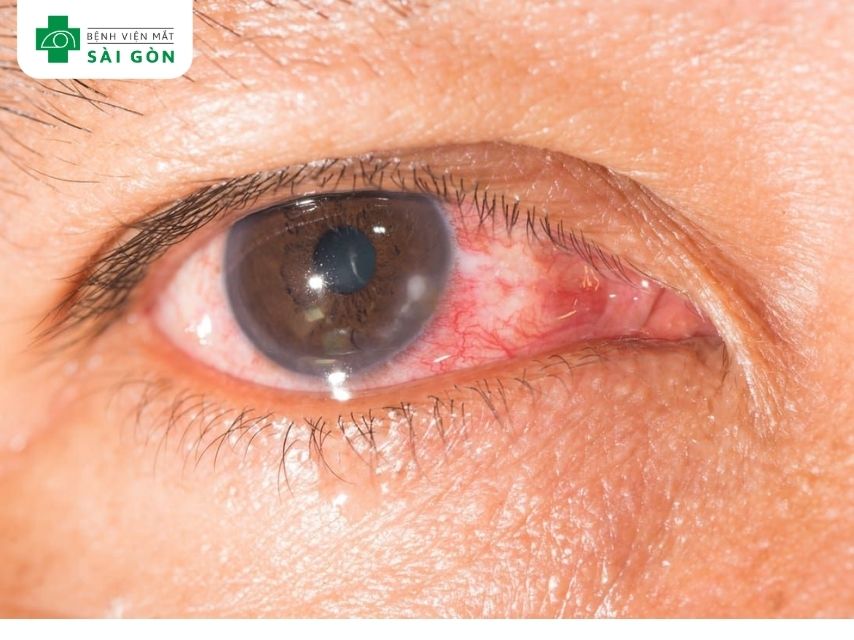 Tình trạng bệnh đau mắt đỏ (viêm kết mạc)