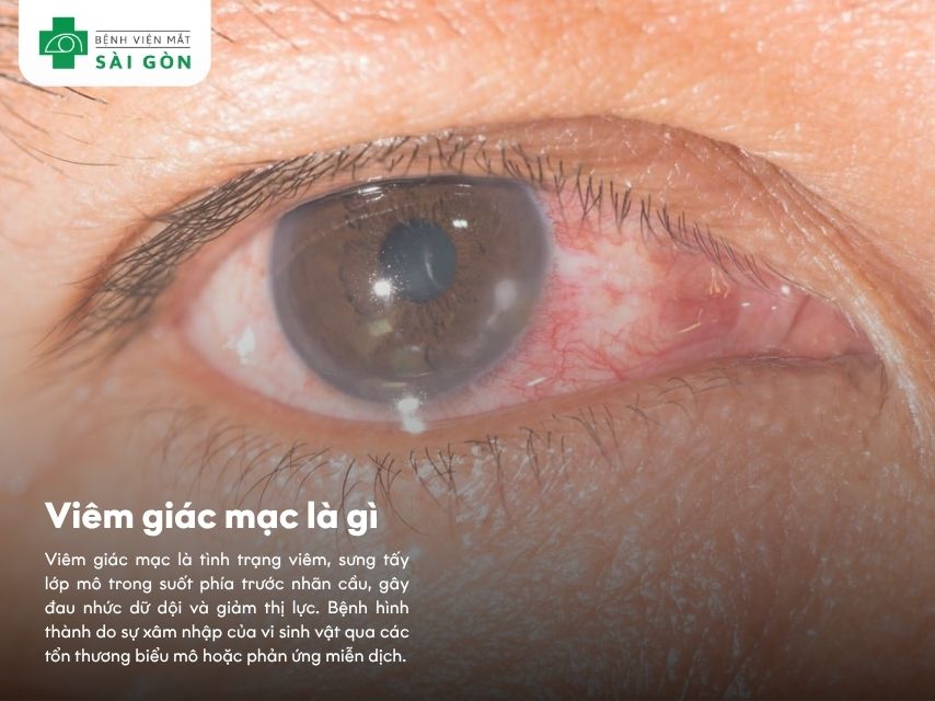 Viêm giác mạc gây đau nhức