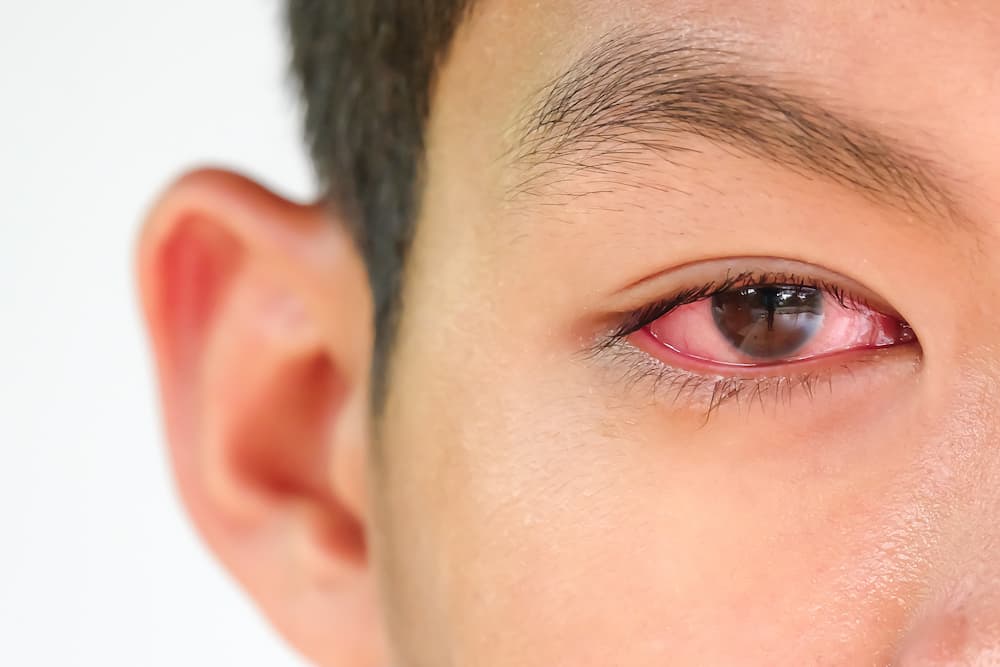 Bệnh viêm kết mạc (đau mắt đỏ) - Bệnh Viện Mắt Sài Gòn