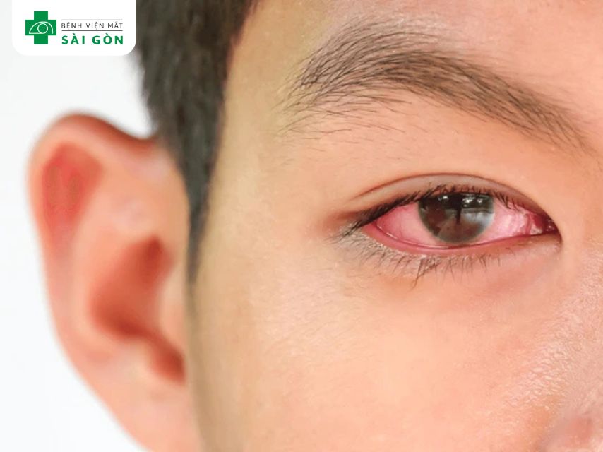 Viêm kết mạc (conjunctivitis)