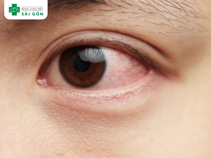 Viêm kết mạc dị ứng gây ngứa khóe mắt do phản ứng với dị vật