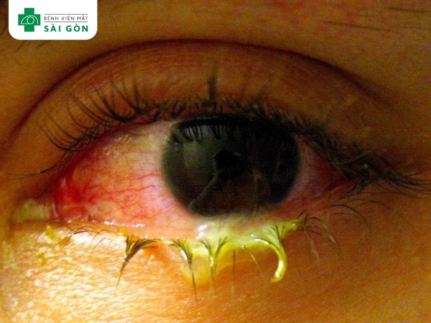Viêm kết mạc do vi khuẩn với triệu chứng dịch mủ màu vàng, xanh và gây đỏ mắt.
