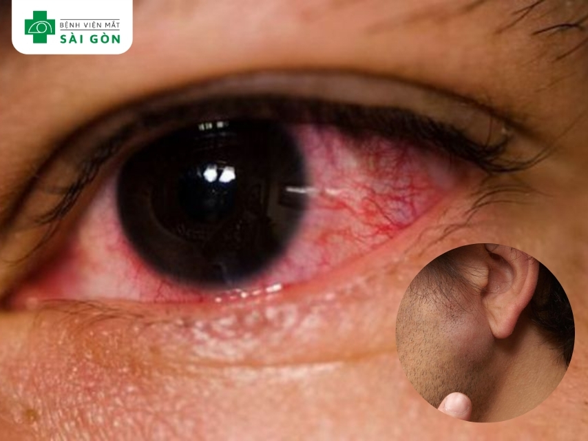 Viêm kết mạc do Viruss gây ra có hạch trước tai và gây đỏ mắt.