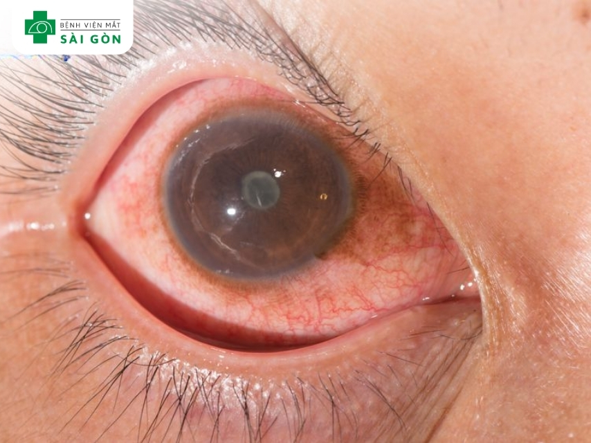 Viêm màng bồ đào là tình trạng viêm toàn bộ hoặc một phần màng bồ đào