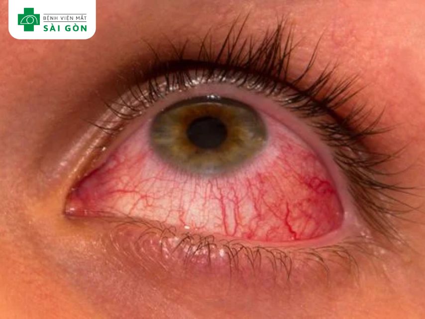 Viêm màng bồ đào