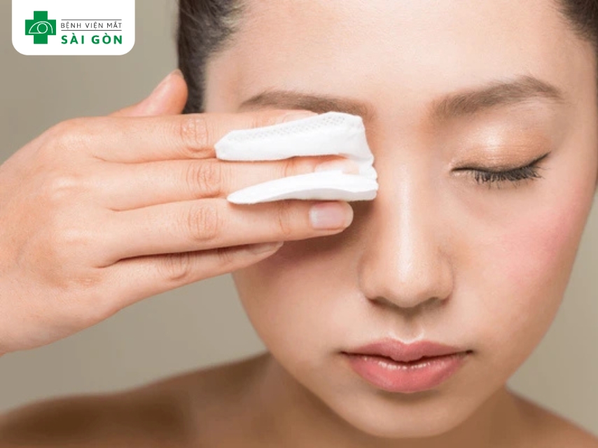 Viêm mí mắt xảy ra khi các tuyến dầu ở gốc lông mi bị tắc