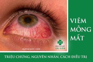 Viêm mống mắt: Triệu chứng, nguyên nhân và cách điều trị viêm mống mắt