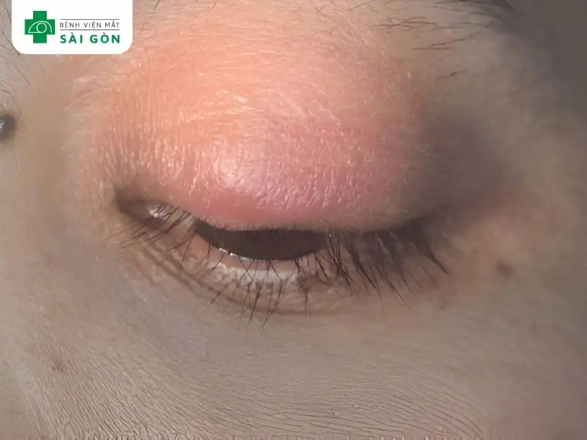 Viêm tế bào ổ mắt