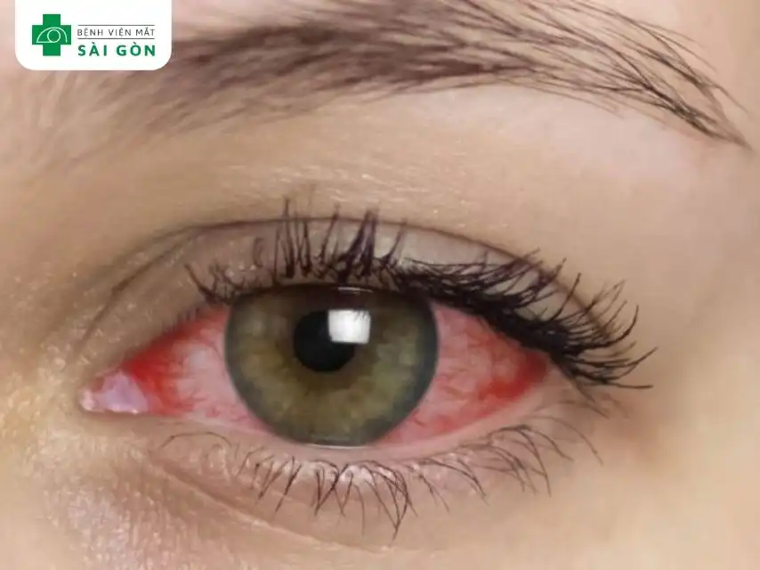 Viêm trong mắt có thể gây vẩn đục dịch kính