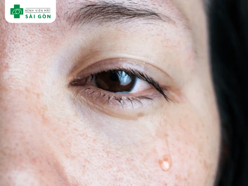 Viêm túi lệ gây ngứa, sưng, đỏ, và đau tại vùng khóe mắt