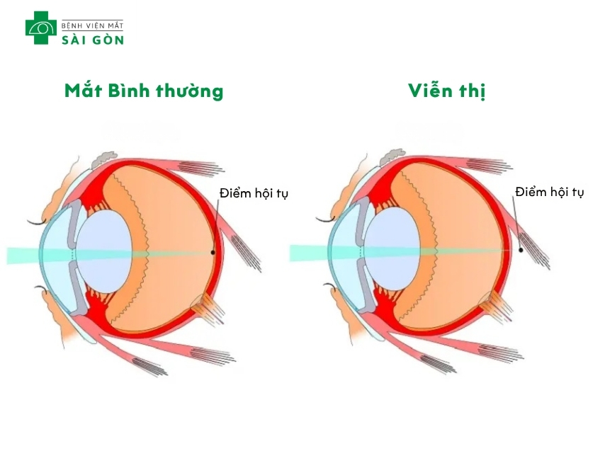 Viễn thị là tình trạng tật khúc xạ đi vào mắt và hội tụ sau võng mạc